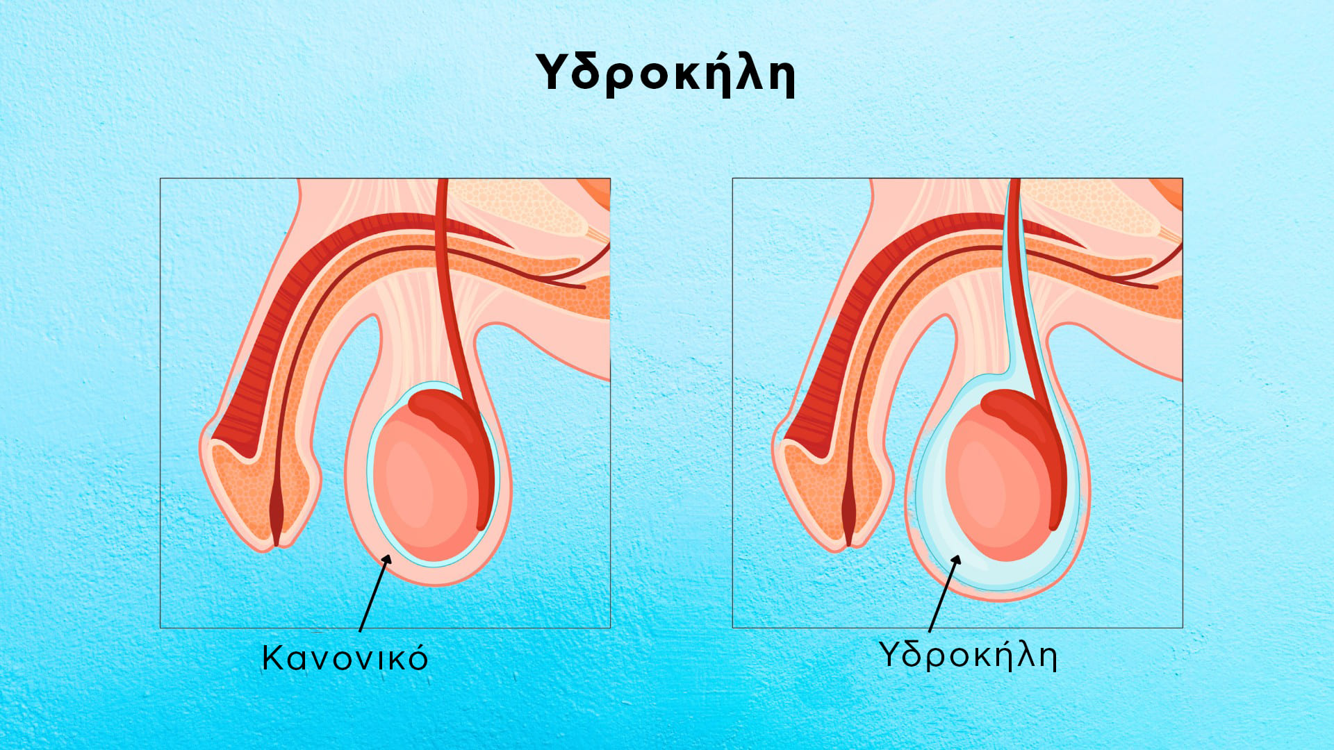 Υδροκήλη