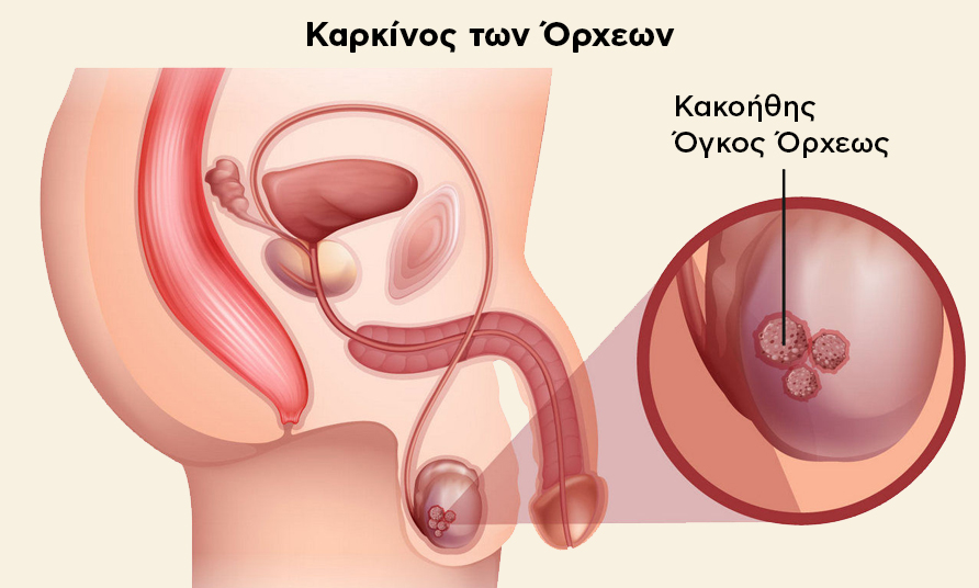 Καρκίνος των Όρχεων