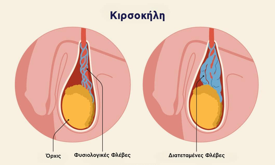 Κιρσοκήλη