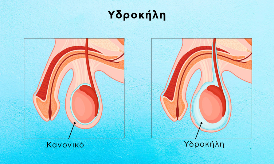 Υδροκήλη