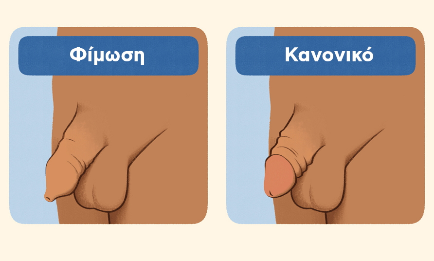 Φίμωση