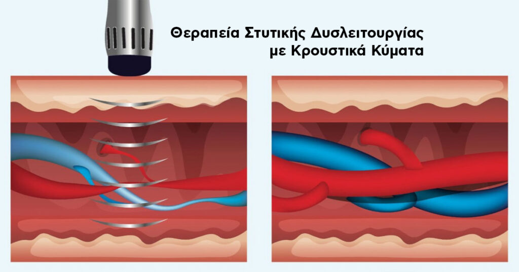 Θεραπεία με Κρουστικά Κύματα