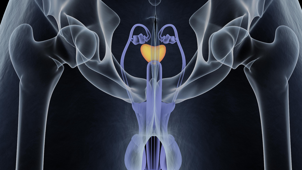 Καρκίνος του Προστάτη